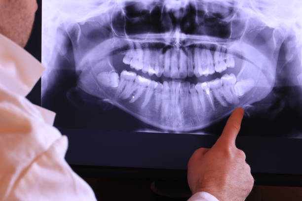 Best Emergency Dentist for Lost Fillings or Crowns in Lake Barcroft, VA